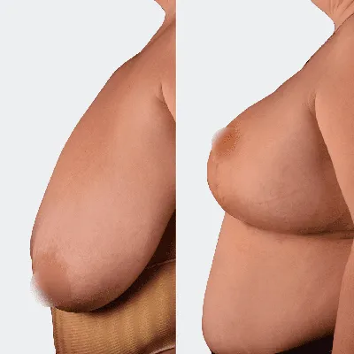 Уменьшение и подтяжка груди от @Dr_Pershukova . Промежуточные результаты  подтяжки груди без имплантов! Консультации бесплатны. Запись… | Instagram
