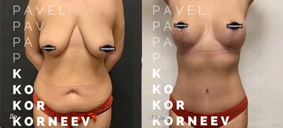 Подтяжка груди ▷ Мастопексия ▷ Подтяжка груди без имплантов в Киеве: цены и  отзывы