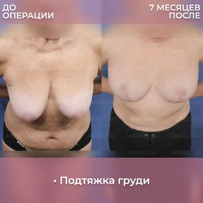 Фото подтяжки груди без имплантов