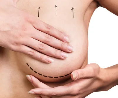 Рубцы и шрамы после мастопексии: какие есть способы коррекции