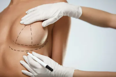 Подтяжка груди в Новосибирске — мастопексия цена в клинике АвисМед