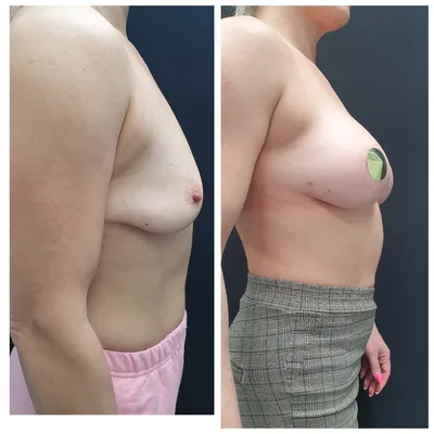 Подтяжка груди (мастопексия) - цена операции без имплантов в Москве в  клинике ОН КЛИНИК