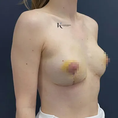 Подтяжка груди без имплантов: как выполняется операция, кому показана и  есть ли минусы