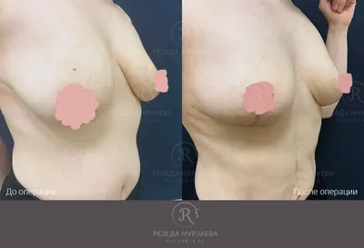 Радиочастотная подтяжка груди Body Tite: вопросы хирургу | Beauty Insider
