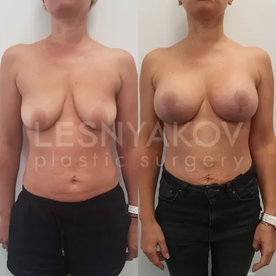 Периареолярная подтяжка груди в Москве - цены, отзывы, реальные фото до и  после | Александр Маркушин пластический хирург