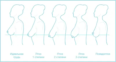 Увеличение груди с имплантами или без? - Майский И. А.