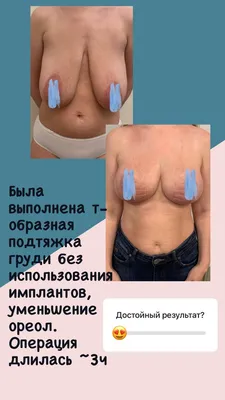 Подтяжка груди: цены от 197 200 руб. в Москве | Мастопексия в «Номосклиник»