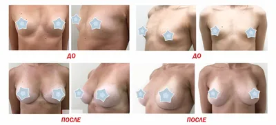 Подтяжка груди в Москве, цены на мастопексию