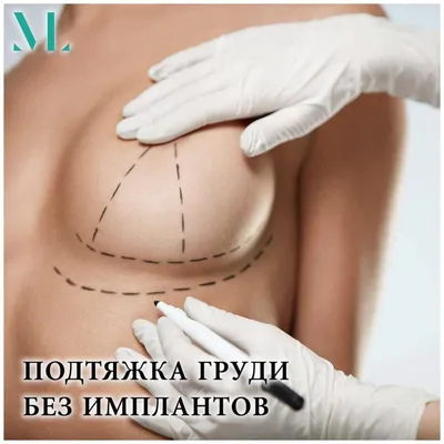Якорная подтяжка груди | Т-образная мастопексия в Москве