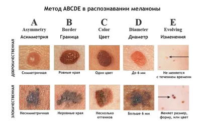 Меланома кожи - о болезни, алгоритм обследования, тесты и анализы