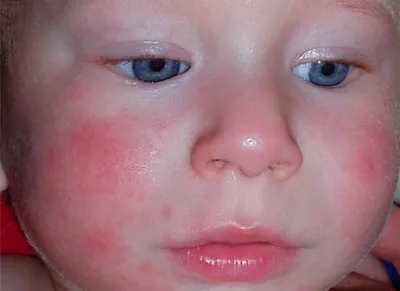 Сыпь вокруг глаз у ребенка: возможные причины, симптомы, необходимая методы  диагностики, варианты лечения, фото