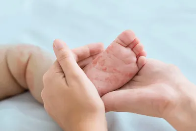 Сыпь у ребенка без температуры: почему появляется и что при этом делать