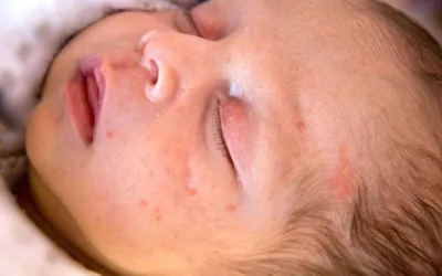 Бесцветная сыпь у ребенка: 📌 популярные вопросы беременных мам и ответы на  них