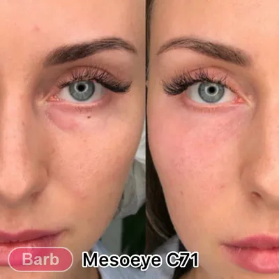 Инъекции Mesoeye - клиника лазерной косметологии в Санкт-Петербурге