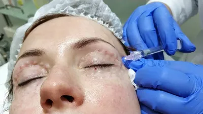 Коррекция кожи глаз препаратом МезоАй ( MesoEye) - ЦИДК