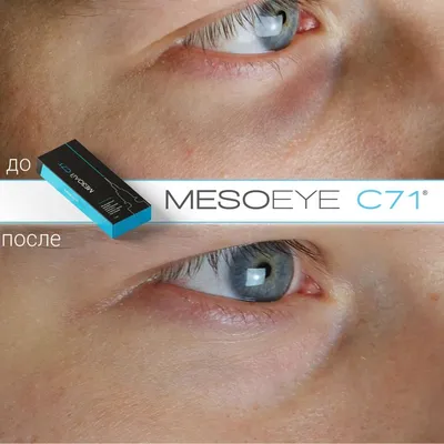 Инъекции MesoEye C71 в Туле - омоложение кожи вокруг глаз, цена в клинике  Комаровой