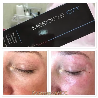 Препарат для биоревитализации MESOEYE C71 (Мезоай Ц71) | Клиника  косметологии PROFESSIONAL в Волгограде