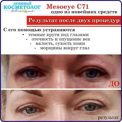 Когда стоит применять Мезоай?