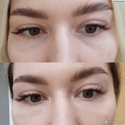 Личный опыт биоревитализация глаз, Mesoeye уколы зоны вокруг глаз, Видео до  и после через неделю - YouTube