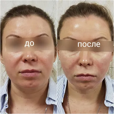 Биоревитализация лица - фото до и после, цена за 1 процедуру Саратов