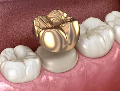 Металлические коронки на зубы: виды, преимущества и недостатки, цены на  металлические зубные коронки