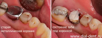 Замена старой металлокерамики на коронки из оксида циркония