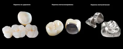 Качественное протезирование зубов в Челябинске - виды и цены на зубные  коронки