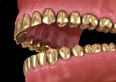Металлические коронки на зубы. В чем плюсы и минусы? Стоимость установки металлической  коронки в СПб в стоматологической клинике DANA (Дана)