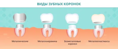 Коронки на зубы — виды и стоимость установки