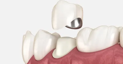 Металлокерамические коронки в Краснодаре, цена с установкой на зуб