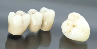 Установка коронок на зубы - цены в Нижнем Новгороде | Стоматология «Имплант  52»