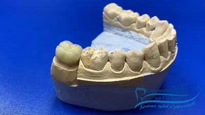 Металлическая коронка на зуб в Перми: цена установки от 5400 руб.
