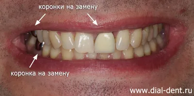 Металлическая коронка на зуб в стоматологической клинике Aliksma