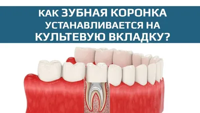 Какие зубные коронки самые лучшие и долговечные? 🦷 iStomatolog, Киев
