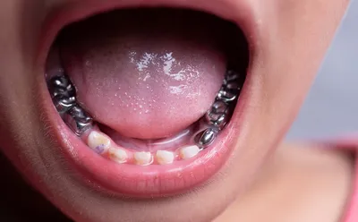Металлические зубные коронки: насколько они долговечны