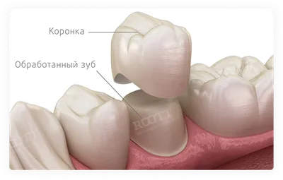 Зубные коронки: зубная коронка на разборной культевой вкладке - YouTube