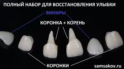 Виды зубных коронок: какие бывают, какие лучше, цены.