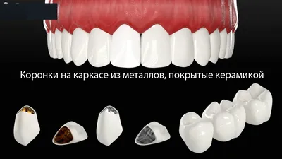 Металлическая коронка на зуб: установка и изготовление, цена в Москве