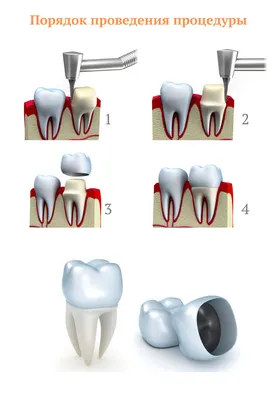 Чем и как почистить искусственные коронки: средства и полезные рекомендации  по уходу
