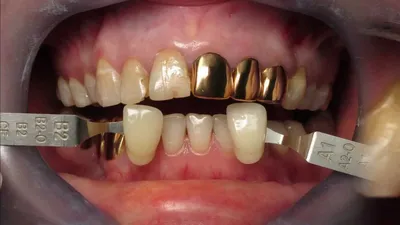 Металлические коронки на зубы — виды, установка, срок службы
