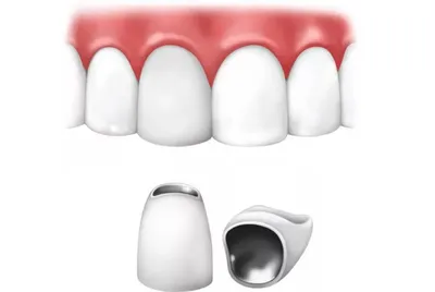 Какие коронки ставят на зубы: виды временных и постоянных коронок