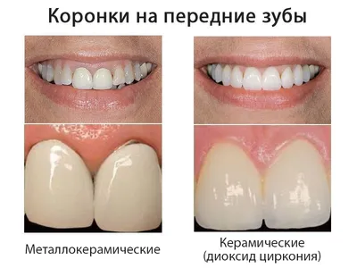 Металлокерамические коронки для зубов и их минусы: фото протезов от  Dominanta74
