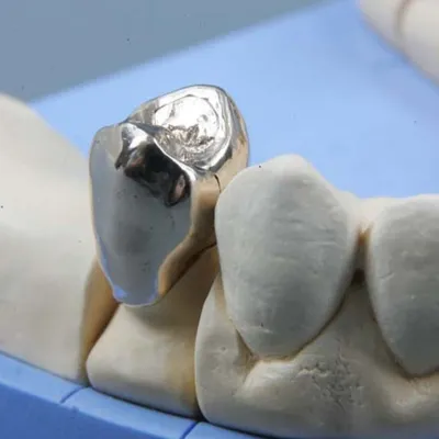 Металлокерамическая коронка на зуб в Саратове - цены с работой по установке  в стоматологии «Дента».