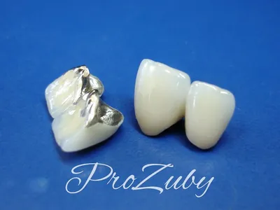 Коронки из диоксида циркония – плюсы и минусы, выбрать циркониевые коронки  на зубы при протезировании | ООО «СВОИ ЛЮДИ»