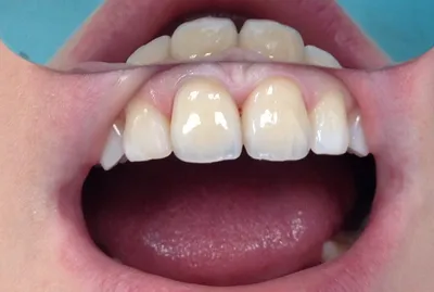 Безметалловые коронки на зубы в Люберцах и Жулебино - цены, этапы, методы