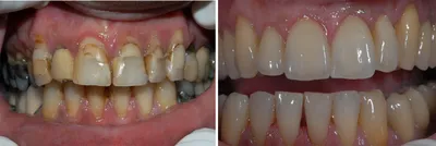 Металлокерамика на передние зубы фото до и после фотографии