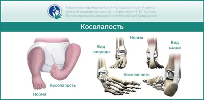 Врождённая косолапость у детей – инновационные методы лечения в России