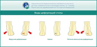 Медицинский центр \"Ортоленд\" - Преимущества метода Понсети: не  хирургическое лечение; раннее начало лечения на первой-второй неделе жизни;  безболезненный метод; не нарушается эластичность связок стопы; не  нарушается подвижность нижней конечности ...