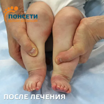 КЛАСС - КЛИНИЧЕСКИЕ СЛУЧАИ КОЛАСЫ ПО МЕТОДУ ПОНСЕТИ - WAPS - World Academy  of Podiatric Science