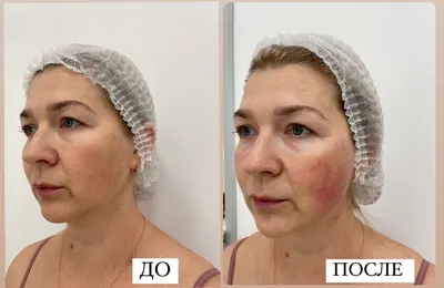 Нитевой лифтинг - подтяжка лица 3D мезонитями в клинике Медицина для Вас на  Красносельской